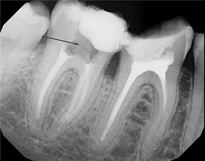 Что такое пульпит зуба и периодонтит