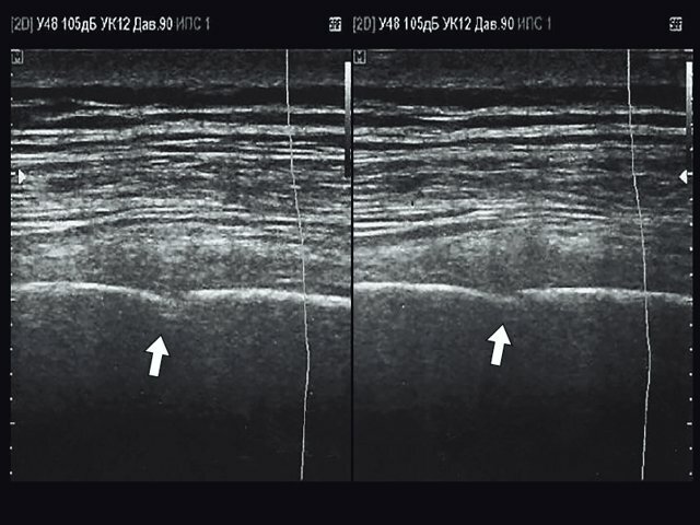 Эхограмма - нарушение кортикального слоя VIII ребра левой половины грудной клетки по задней аксиллярной линии (указано стрелкой)