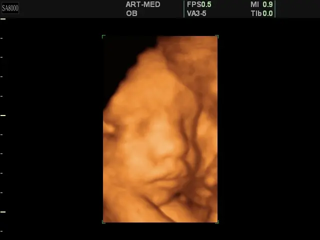 Фото трехмерного УЗИ на 31 неделе беременности