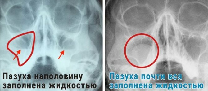 Гайморит на снимке рентгена - как выглядит, фото и описание
