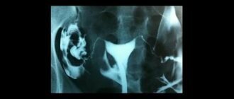 Как делают рентген маточных труб