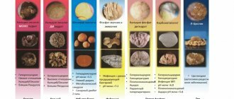 Камни мочевыделительной системы.png