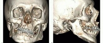 КТ костей лицевого скелета