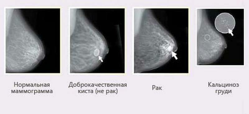 Маммография и флюорография в один день: за и против
