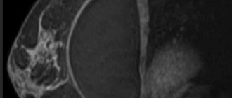 МР-снимок молочной железы с имплантатом