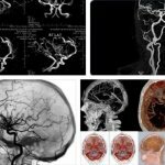 МРТ сосудов головы и шеи в режиме ангиографии