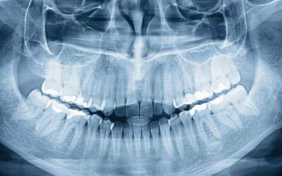 Панорамный снимок зубов - Стоматология Линия Улыбки