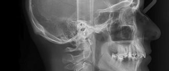 Рентген костей носа