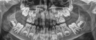 рентгена зубов