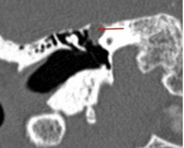 Шваннома лицевого нерва: осевое КТ-изображение (костное окно) демонстрирует расширение ганглия, присутствует однородная масса мягких тканей (стрелка)