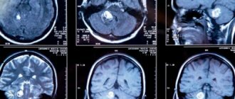 Снимок МРТ при опухоли головного мозга