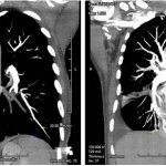 Снимок МРТ при туберкулезе легких