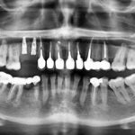 снимок рентгена зубов