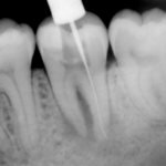 Снимок зубов на этапе лечения