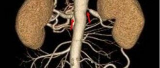 Стрелками обозначены участки сужения почечных артерий, выявленные на КТ