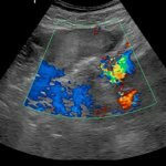 Ультразвуковая допплерография маточно-плацентарного кровотока